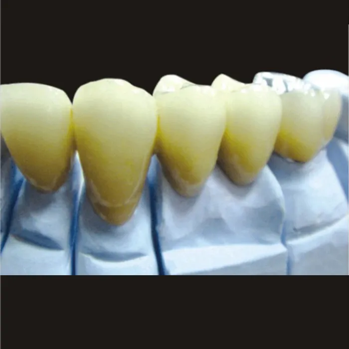 Nikkelikromiposliinihampaat